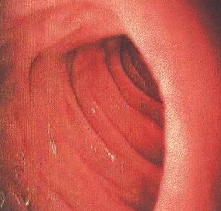 Vue endoscopique d'un duodénum normal
