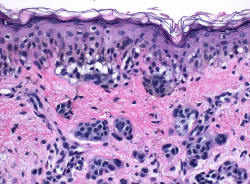 Coupe histologique colorée à l'hématoxyline-éosine : nævus composé